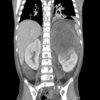 Large neuroblastoma above left kidney CT scan coronal view