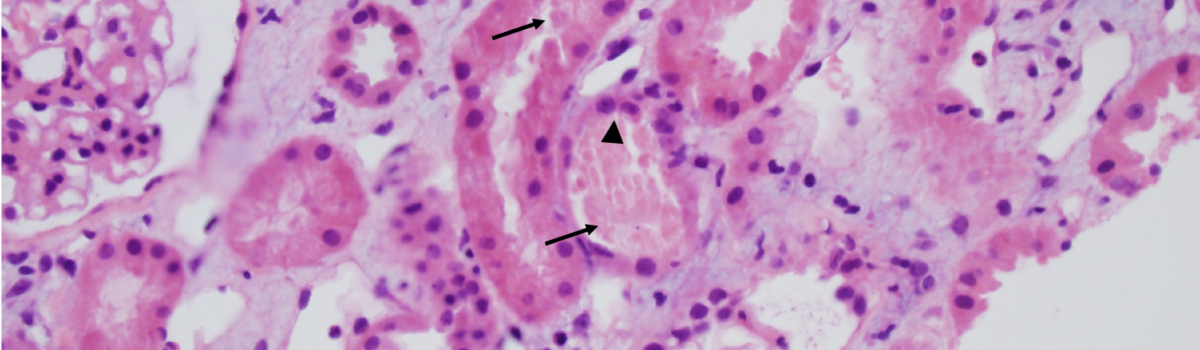 Acute Tubular Necrosis Histology