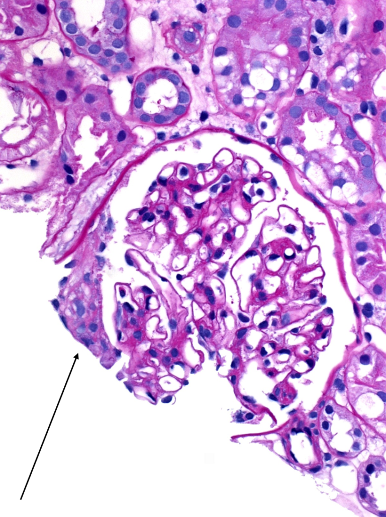 crescentic-glomerulonephritis-american-society-of-pediatric