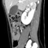 Acute pyelonephritis on CT scan with contrast sagittal view