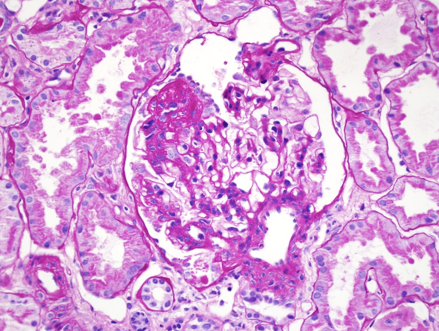 Focal Segmental Glomerulosclerosis - American Society Of Pediatric ...