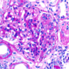Segmental glomerulosclerosis in IgA nephropathy